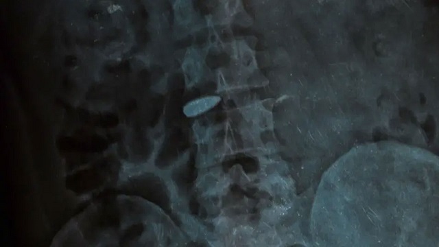 বুলেট আটকে আছে মেরুদণ্ডে