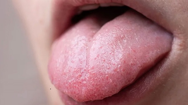 চিকিৎসকের কাছে গেলে আগে জিভ দেখাতে বলে কেন?