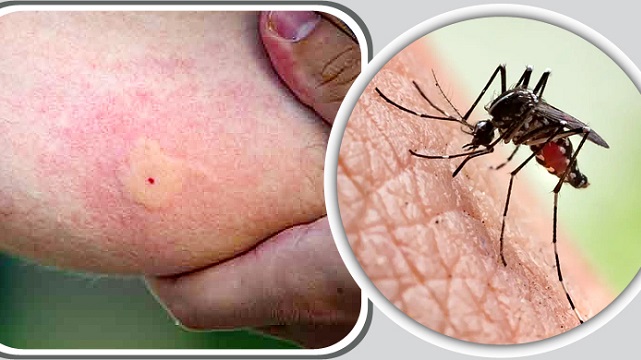 মশার কামড়ে শরীরে দাগ হলে কী করবেন