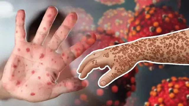 হাম ও উপসর্গে আরও ৭ শিশুর মৃত্যু