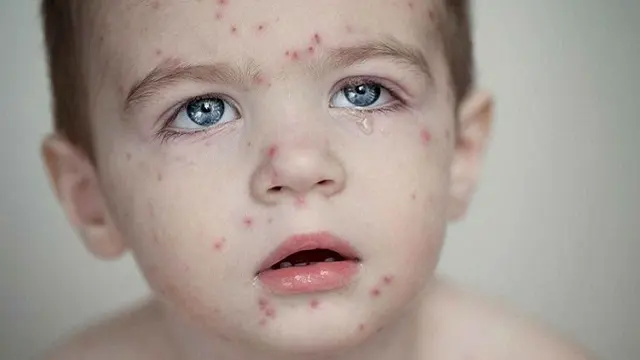 হাম ও উপসর্গে আরও ১০ শিশুর মৃত্যু