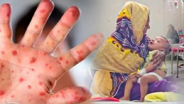 হাম ও উপসর্গে আরও ১০ শিশুর মৃত্যু