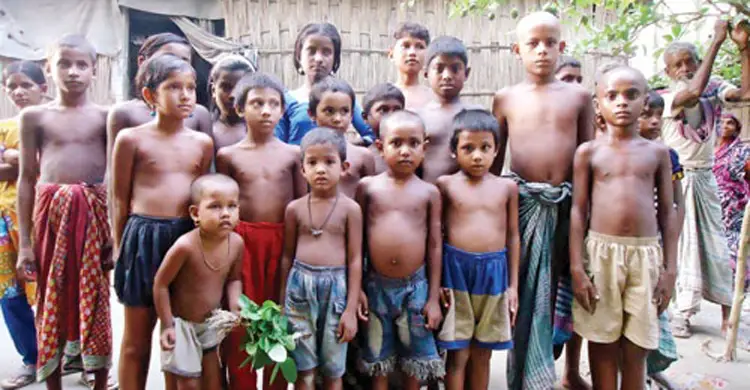 গাজায় ৫৫ হাজার শিশু তীব্র অপুষ্টিতে ভুগছে