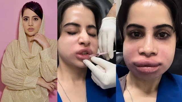 ঠোঁট সুন্দর করতে গিয়ে মুখটাই নষ্ট! উরফি জাভেদের কষ্টের কাহিনি