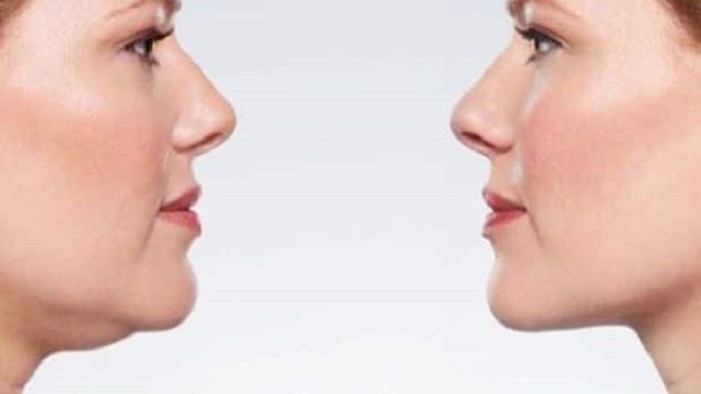  গালের চর্বি কমানোর উপায়