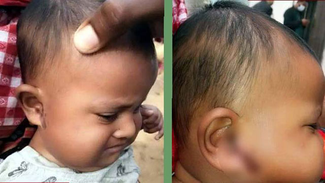 গাজীপুরে শিশুকে এসিড নিক্ষেপের অভিযোগ