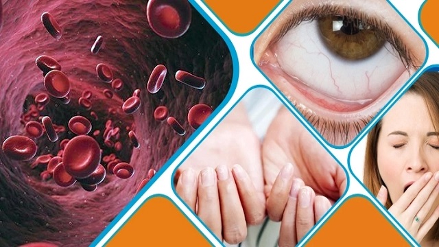শরীরে আয়রনের ঘাটতি জানান দিবে যে লক্ষণ
