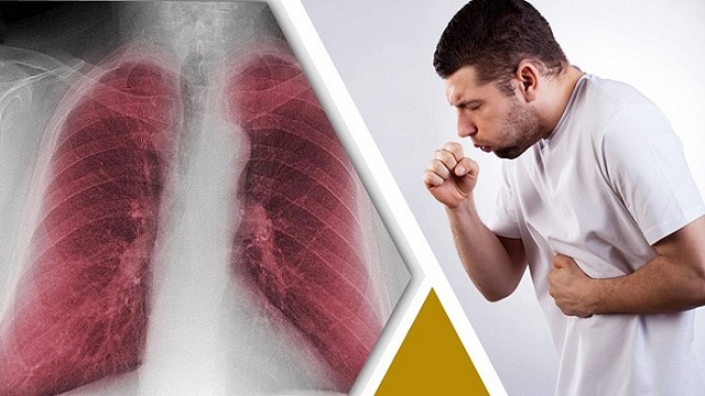 জেনে নিন ফুসফুসে ক্যান্সারের ধরণ,কারণ ও প্রতিরোধে করণীয়