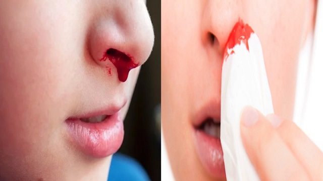 হঠাৎ নাক দিয়ে রক্ত পড়লে করনীয় কী?