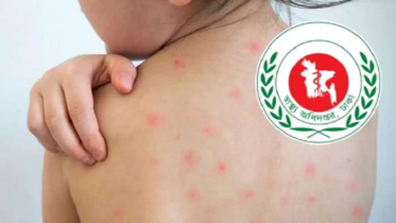  8 more children have died from measles and its symptoms in last 24 hours