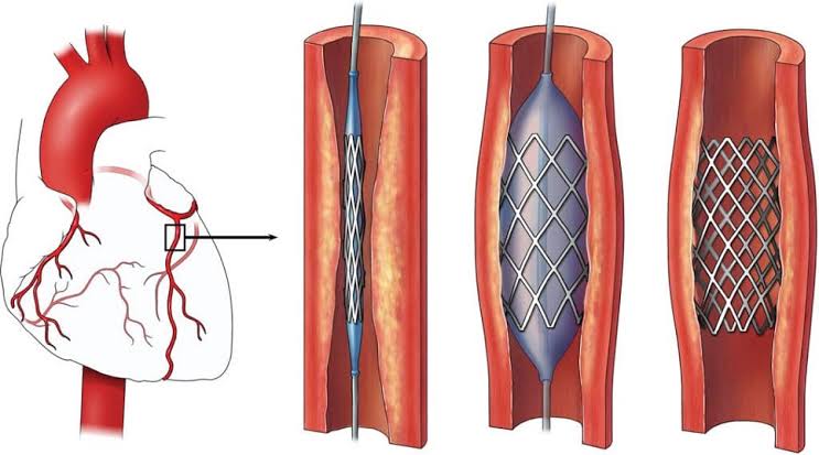 Reduced base prices of cardiac stents to be effective from Sept 1